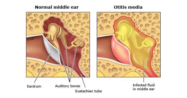 otitis inner ear