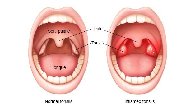 tonsillectomy graphic