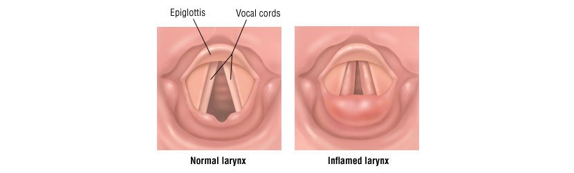 Laryngitis Michigan ENT Allergy Specialists