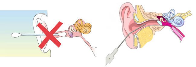 Don't clean your ear with a q-tip