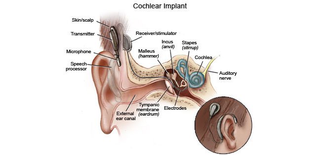 Graphic displaying how a cochlear implant works
