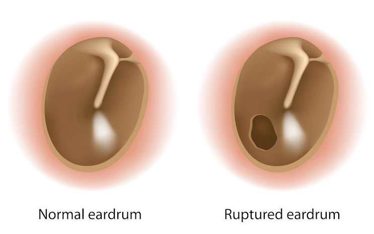 Display of a normal eardrum vs a ruptured eardrum