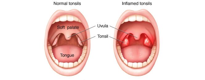 Graphic of normal tonsils vs inflamed tonsils