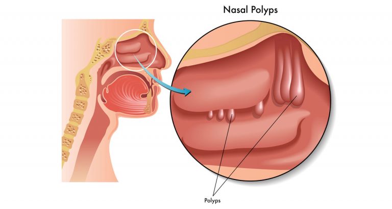 Graphic of side of head and close up on Nasal Polyps