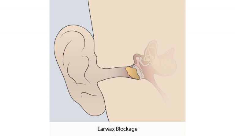 Diagram of Earwax Blockage