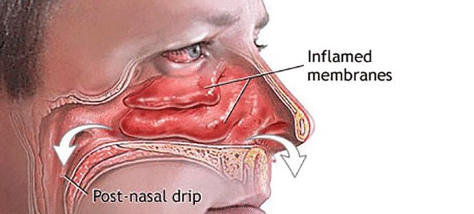 Graphic displaying inflamed membranes and post-nasal drip