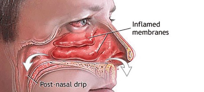 What Does Watery Eyes And Runny Nose Mean