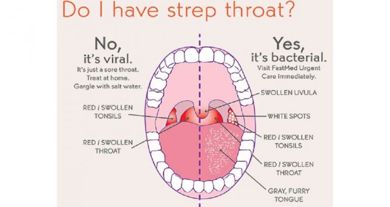 A diagram showing a healthy mouth on one side and a mouth with strep throat on the other