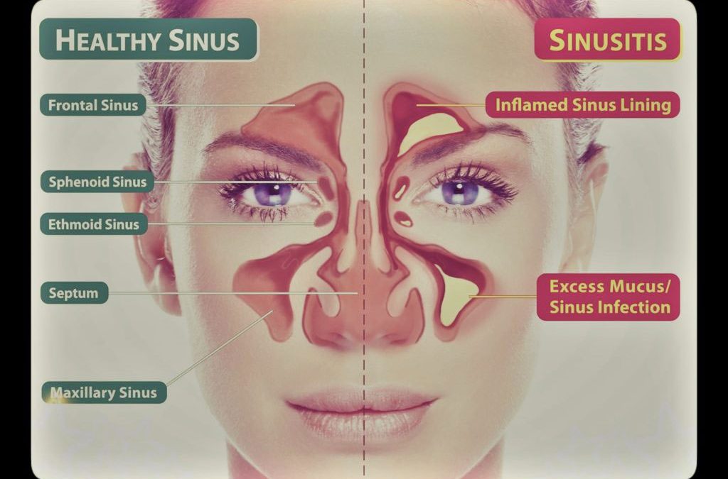 Can U Get Sinus Infection With Covid