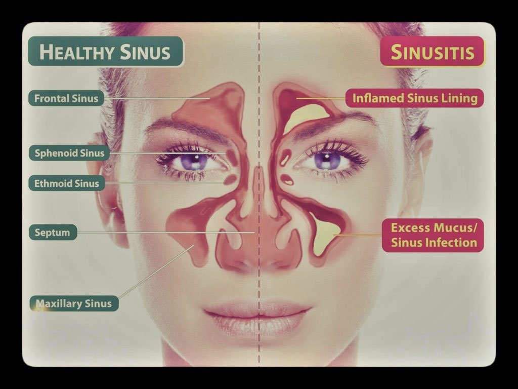 Two sides of a womans face with one depicting healthy sinus and the other sinusitis