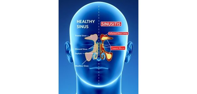 Graphic of the human head with one side showing the inner workings of a healthy sinus and the other of sinusitis