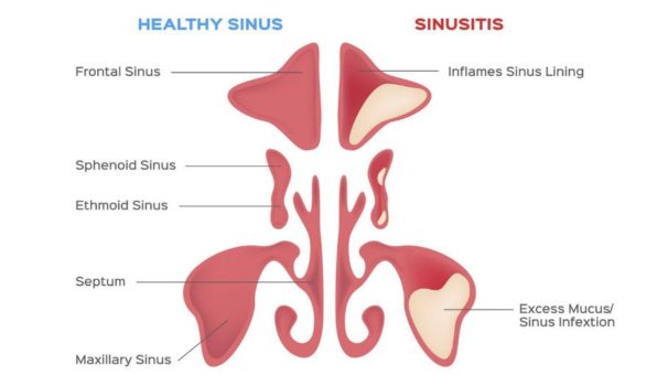 Chronic sinus infections can have a significant impact on our quality of life