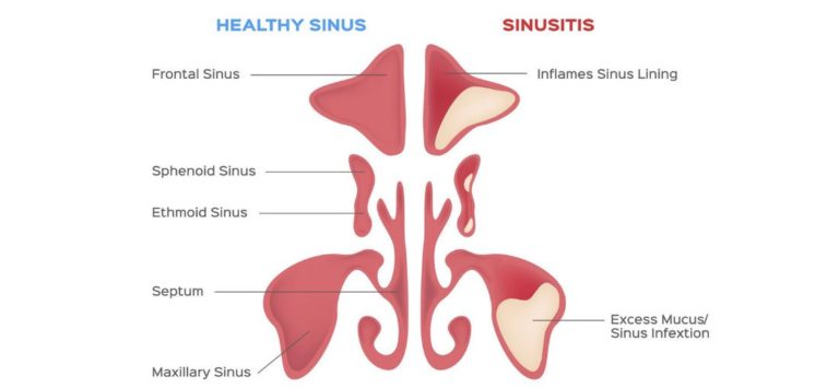 Graphic displaying two sinus sides of the nose one that is a healthy sinus and one that has sinusitis
