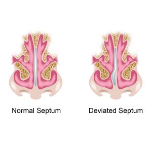 Deviated Nasal Septum Michigan Ent Allergy Audiology
