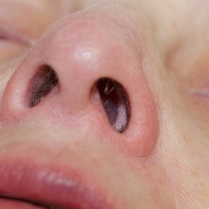sinus nasal polyps