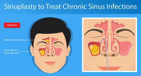 There Are Many Things We Can Do To Treat The Sinuses - Michigan Ent 