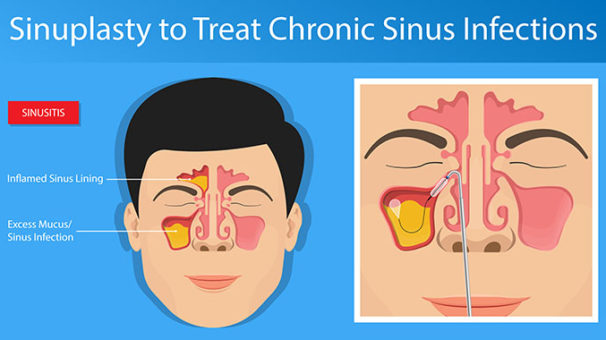There are many things we can do to treat the sinuses